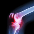 6233 (Xl) Knee Cap For Knee Support - Shop Gharse