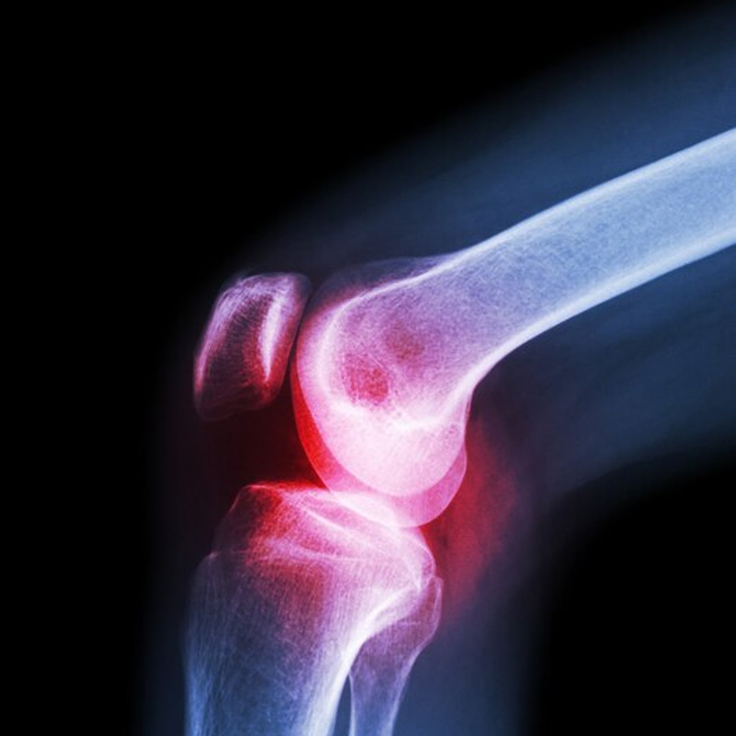 6233 (Xl) Knee Cap For Knee Support - Shop Gharse